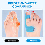 🎉Summer Sale - 49% OFF - Bunion Relief Toe Correction Wrap